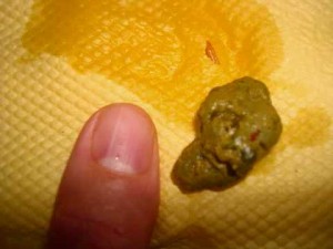 Home remedies To Remove Stones From Gall Bladder