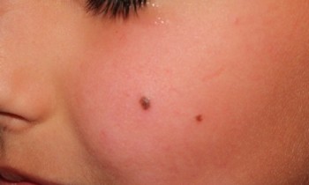 Best remedies to get rid of moles