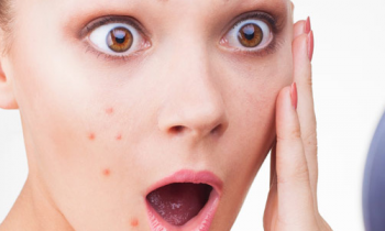 Effective Home Remedies To Get Rid Of Blemishes