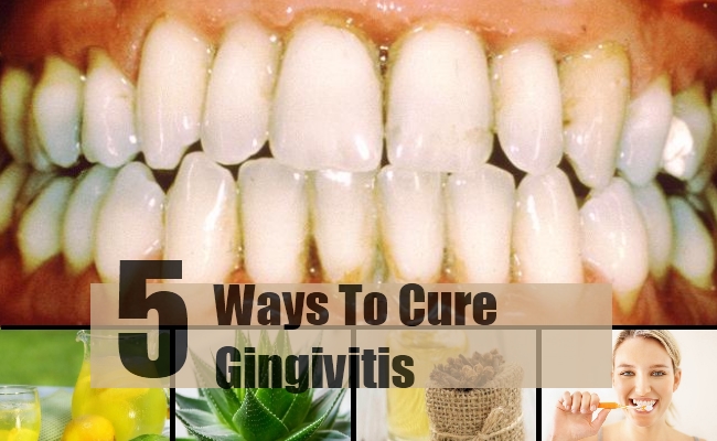 Herbal Remedies For Gum Infection