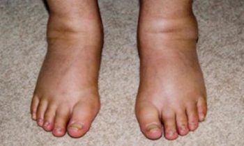 Home Remedies For Fluid Retention