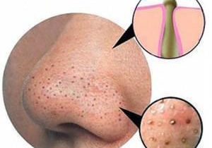 Best Home Remedies To Get Rid Of Blackheads