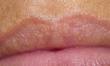 Causes of Fordyce spots on upper lip