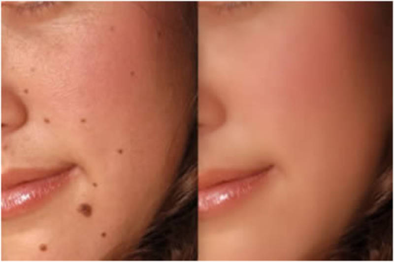 Best Remedies To Get Rid Of Moles
