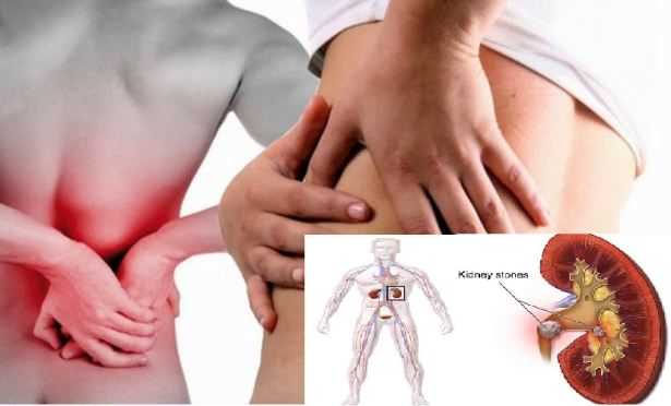 Six Cures To Flush Out Kidney Stones