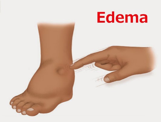 12 Effective Home Remedies For Fluid Retention